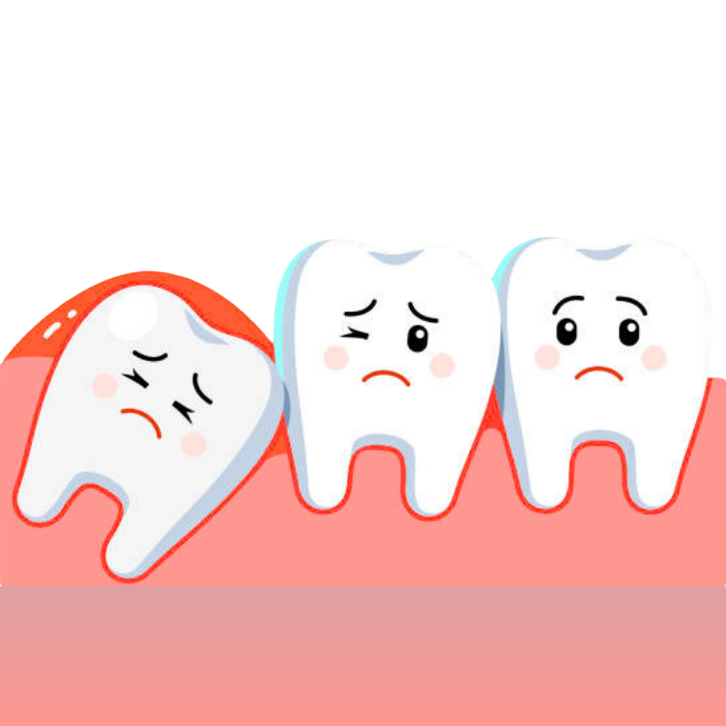 Impaction